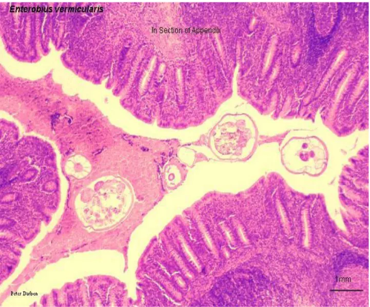 Figure 9 : Adultes d’Enterobius vermicularis en coupe sur une pièce  d’appendicectomie  [4’] 