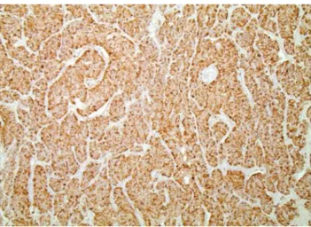 Figure 15:La coloration immunohistochimique de la tumeur a montré qu'elle exprimait  fortement la chromogranine, l'énolase spécifique des neurones (NSE) et la 