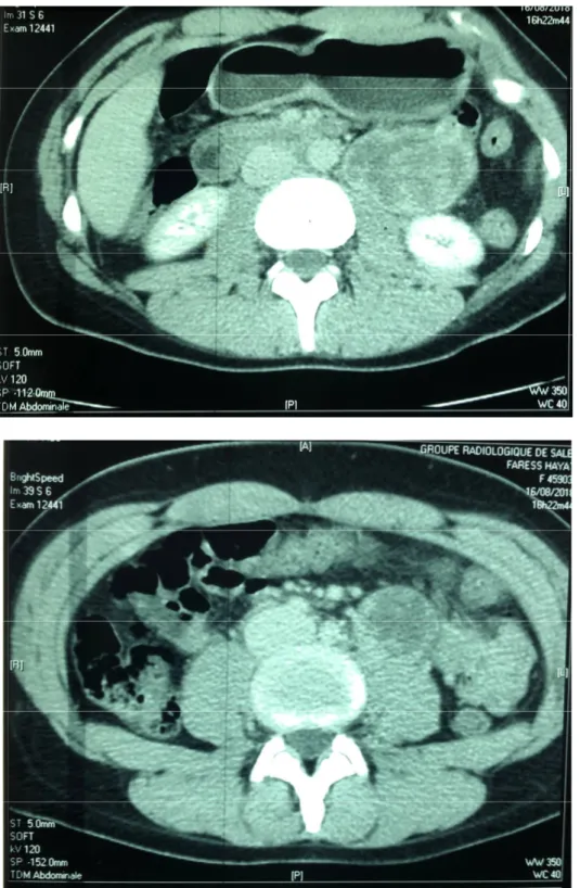 Figure 18: images scannographiques démontrant la localisation et la taille de la tumeur  ainsi que son rehaussement en périphérie