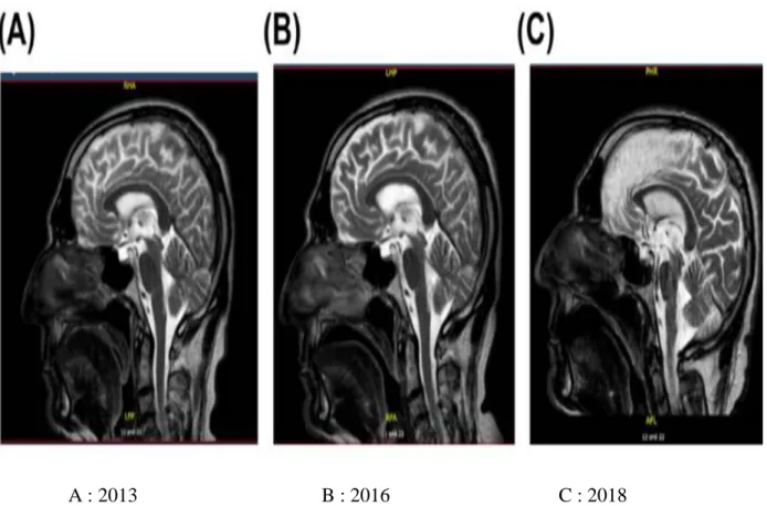 Figure 7: IRM cérébrale en coupes sagittales T2 d’un patient souffrant d’une PSP,  objectivant une atrophie du mésencéphale (signe de colibri) et l’atrophie frontale 