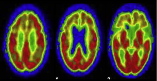 Figure 8: TEP cérébrale au 18FDG chez une patiente de 65 ans atteinte de PSP-P. Notez  l'hypométabolisme fronto-cingulaire mésial et orbitofrontal et la relative préservation  des aires postérieures et des ganglions de la base