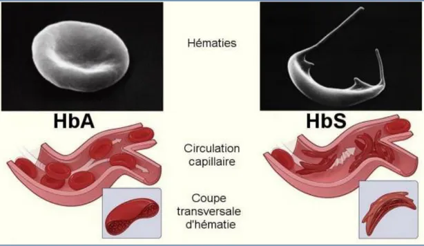Figure 8: Comparaison entre l’HbA normale et l’HbS drépanocytaire  