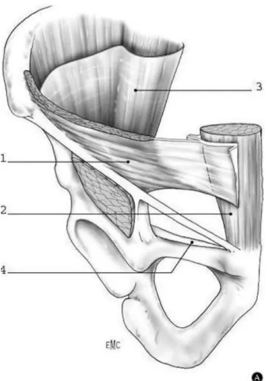 Figure 4 : Cadre solide de l'aine et trou musculo-pectinéal  1. Petit oblique ; 2. Grand droit ; 3