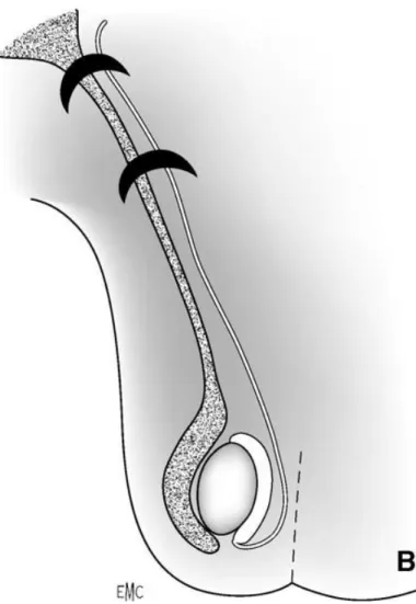 Figure 9 : Hydrocèle de la vaginale 