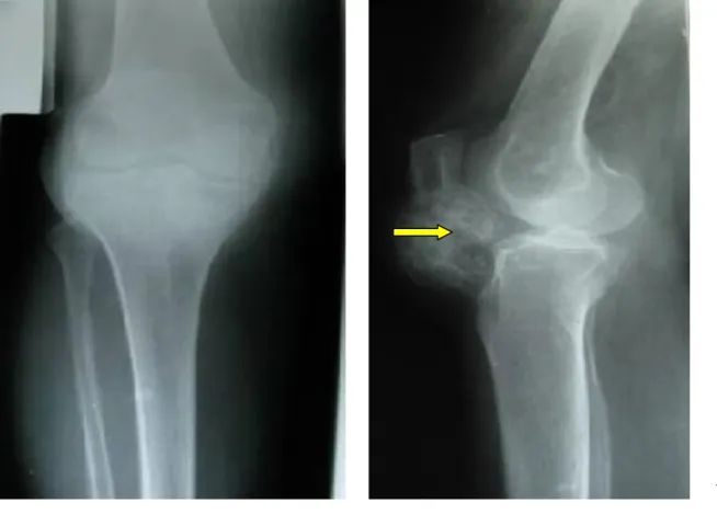 Figure 1: formation calcifiée sous patellaire se projetant dans l’aire du PAH (observ1)