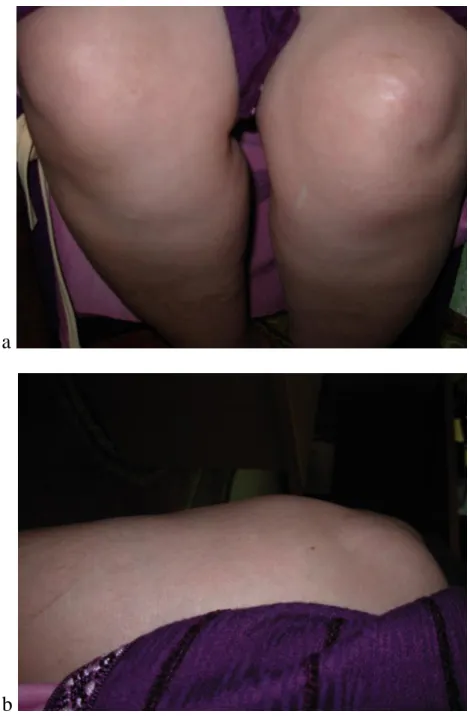 Figure 5 a, b : tuméfaction sous patellaire gauche 