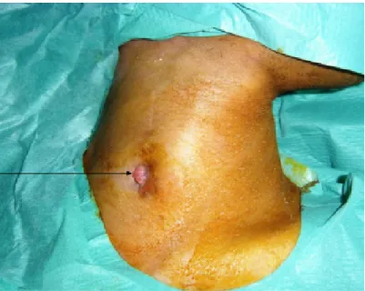 Figure 4 : Fistule cutanée 