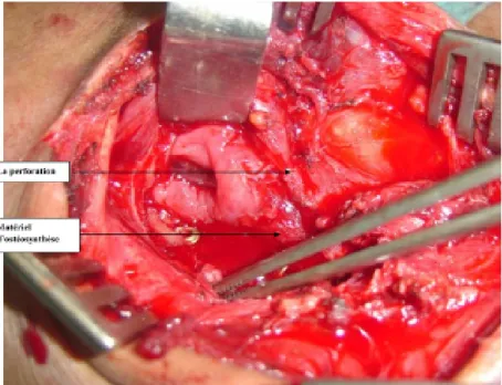 Figure 5 : La perforation de l’œsophage cervical sur matériel d’ostéosynthèse  cervical 