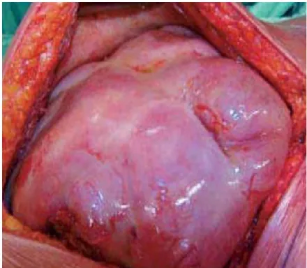 Figure 7 : Vue opératoire montrant une membrane   fibreuse blanchâtre engainant le tube digestif