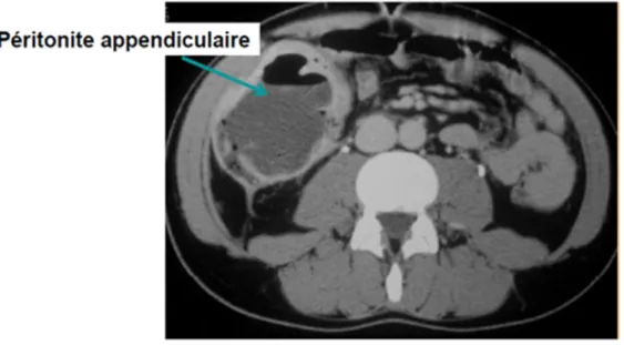 Fig 8 : Cliché de TDM abdominale montrant une collection hypo dense à paroi épaisse  prenant le contraste en faveur d’une péritonite appendiculaire 