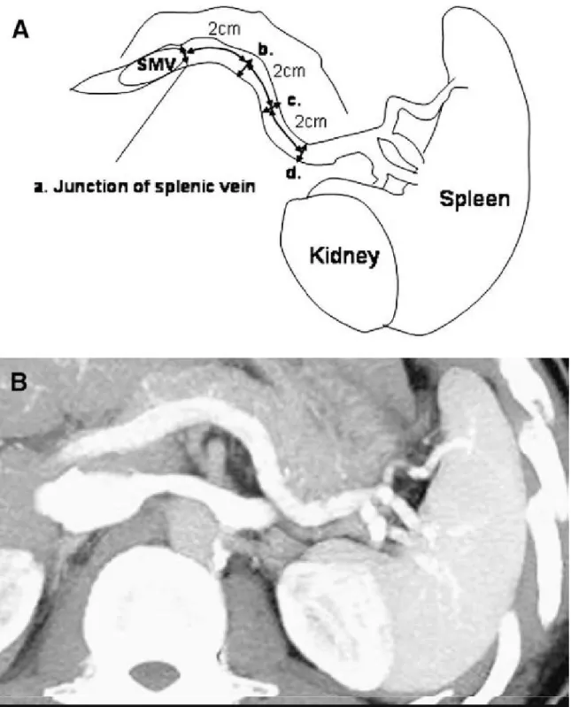 Figure 9: Image numérique tomographique transaxiale, et sa représentation  schématique montrant la mesure du diamètre de la veine porte à la jonction 