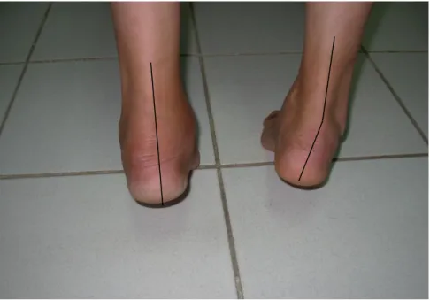 Figure A3. En appui sur la pointe des pieds on note l’absence de  la varisation du talon gauche 