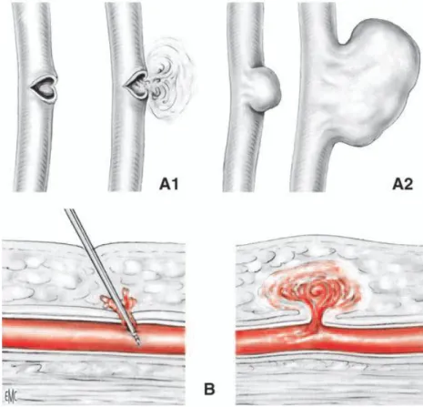 Figure 7 : Plaie artérielle franche avec section incomplète [7] 