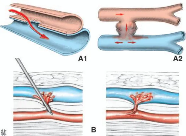 Figure 8 : Fistule artérioveineuse [7] 