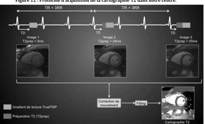Figure 12 : Protocole d’acquisition de la cartographie T2 dans notre centre.