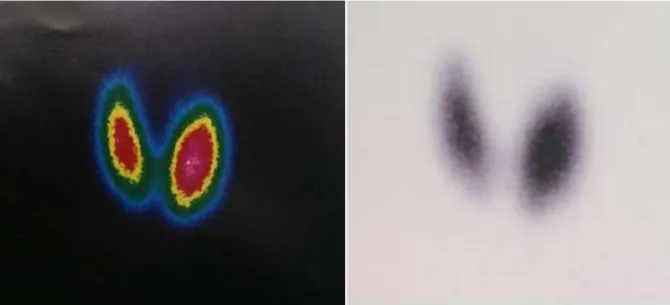 Figure 17 : Scintigraphie thyroïdienne montrant une glande augmentée de taille, de contours  réguliers et de captation très intense 
