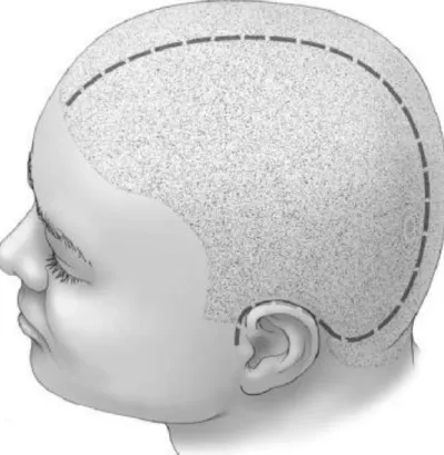 Figure n° 4: L’incision curviligne de l’hémi-craniectomie  [48]