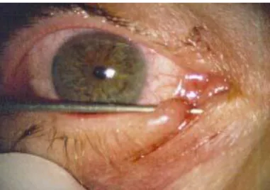 Fig. 15 : Introduction de la sonde de Bowman   après dilatation du méat lacrymal. 