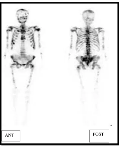 Figure 10 : Scintigraphie osseuse en vue antérieure (gauche) et postérieure (droite) chez un  patient atteint d’adénocarcinome prostatique avec multiples métastases osseuses, 24 heures 