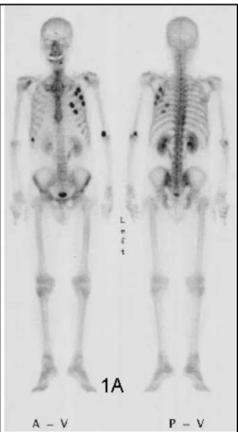 Figure 28 : Scintigraphie osseuse au 99mTC-MDP montrant des lésions avec accumulation dans  les côtes gauches (31) :
