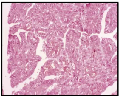 Figure  31 : Carcinome papillaire : aspect des formes usuelles d’architecture papillaire