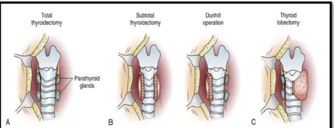 Figure 34 ; les types de chirurgie de la thyroïde [30] 