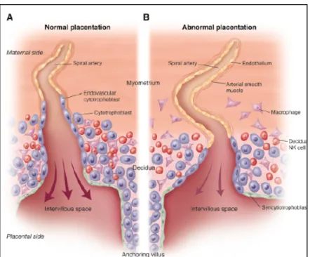 Figure 1 : Le défaut de placentation avec la prééclampsie.  