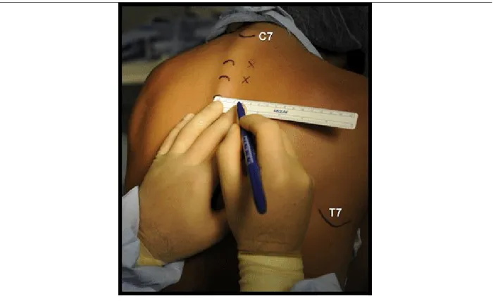 Figure 5.  Les  points  d'insertion  de  l'aiguille  pour  le  bloc  paravertébral  sont  étiquetés à 2,5 cm latéralement aux apophyses épineuses   