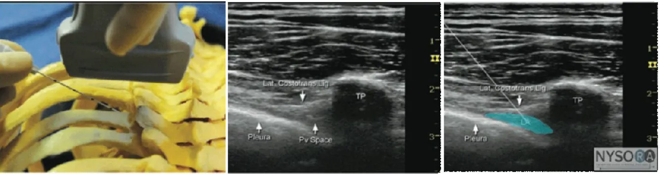 Figure 10. Approche transversale guidée par échographie au niveau thoracique.  Adapté de NYSORA (29) 