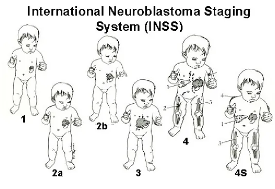 Figure 5.  Stade des tumeurs de neuroblastomes en fonction du INSS :  