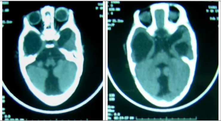 Figure 9 : TDM cérébrale en coupes axiales mettant en évidence une hydrocéphalie sur une      malformation de Dandy-Walker