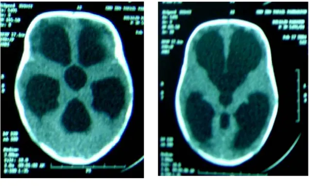 Figure 10 : TDM cérébral en coupes axiale objectivant une hydrocéphalie tétraventriculaire  avec  résorption transépendymaire sur malformation de Dandy-Walker