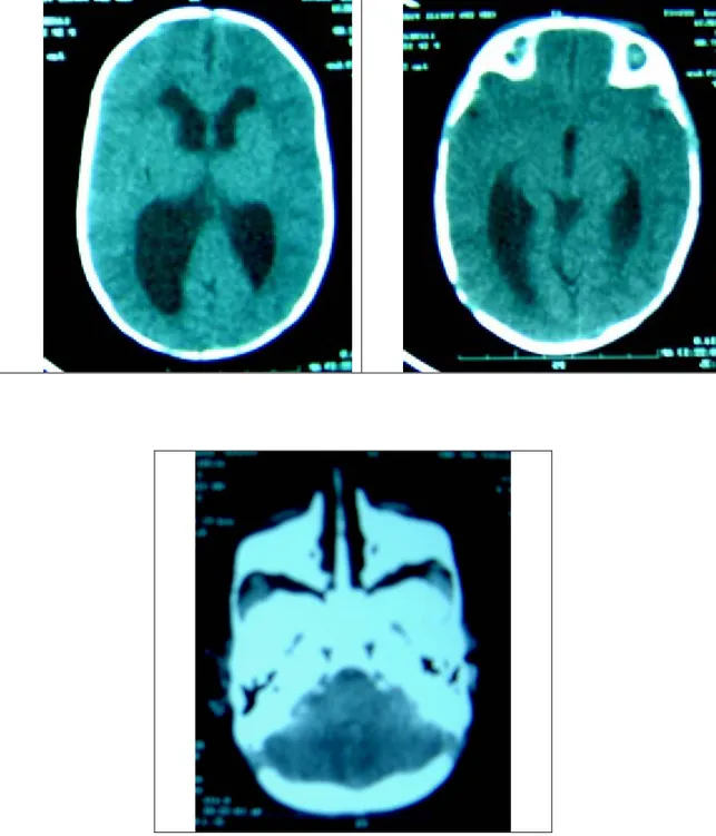Figure 11 : TDM cérébrale en coupes axiales mettant en évidence une hydrocéphalie  triventriculaire en rapport avec sténose de l’aqueduc de Sylvius