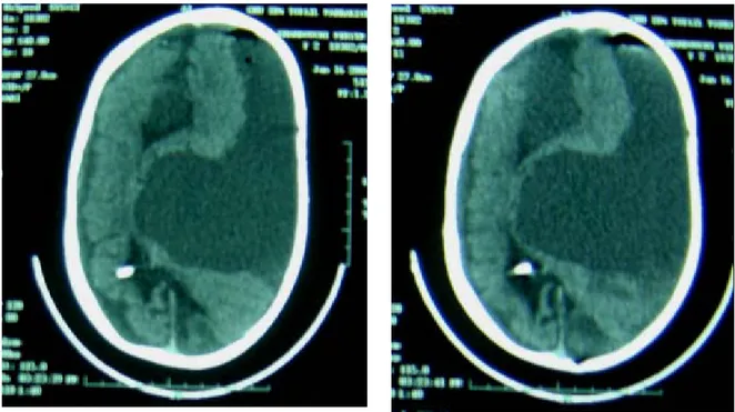 Figure 13 : Scanner cérébral en coupes axiales, objectivant une collection hypodense  hémisphérique bilatérale en rapport avec un hyperdrainage