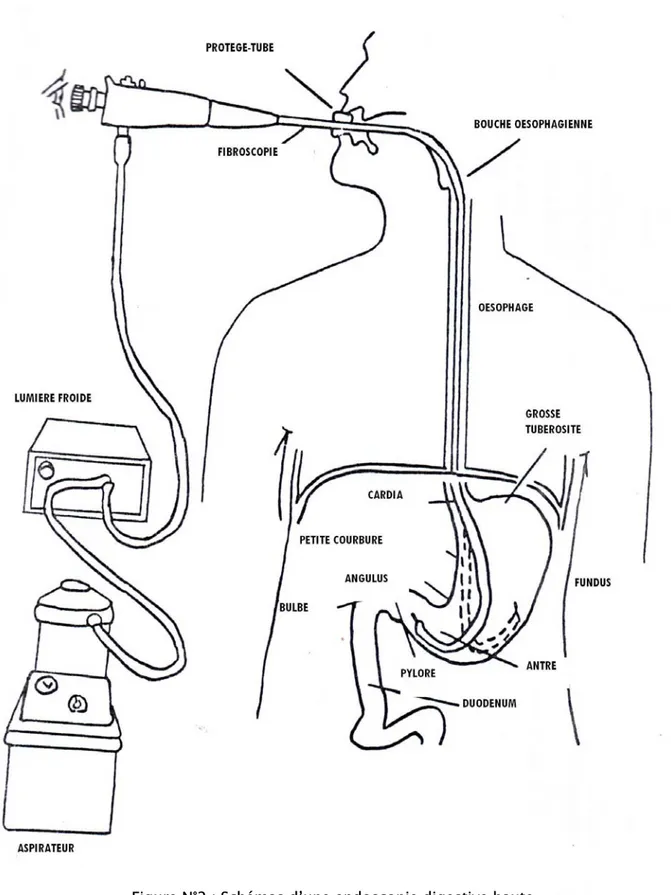 Figure N°2 : Schémas d’une endoscopie digestive haute 