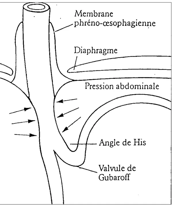 Figure N°5 : Barrière anti-reflux 