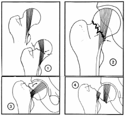 Fig. 2 : Classification de Garden. 