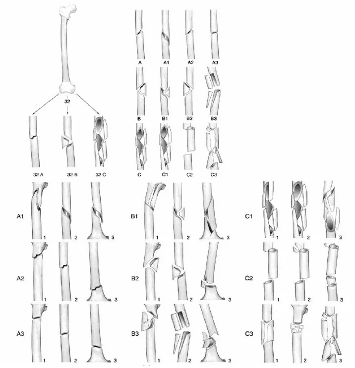 Fig. 3 : La classification de l’AO de la diaphyse fémorale. 