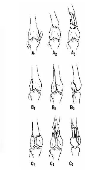 Fig. 5 : La classification de l’AO de l’extrémité inférieure du fémur. 