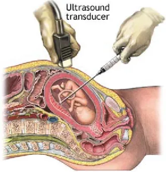 Figure 6 : Cordocentèse 
