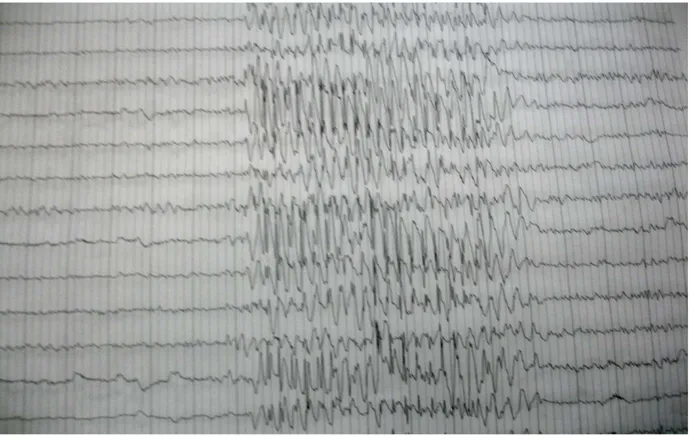 Figure 5 : Décharge bilatérale symétrique et synchrone de complexes pointes-ondes régulières à  3 par seconde sur un fond de tracé normal chez un enfant de 12 ans présentant des absences 