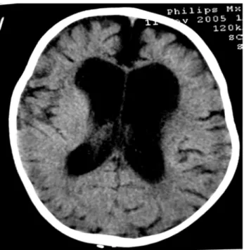Figure n° 7 : Tomodensitométrie cérébrale montrant une  atrophie cortico sous corticale avec dilatation des ventricules  chez un enfant de 13 ans présentant un syndrome de Lennox_Gastaut