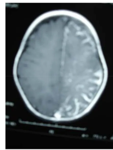 Figure 3 : IRM en coupe axiale T1avec injection : angiome leptoméningé fronto-pariéto-occipital  gauche et angiome du plexus choroïde homolatéral