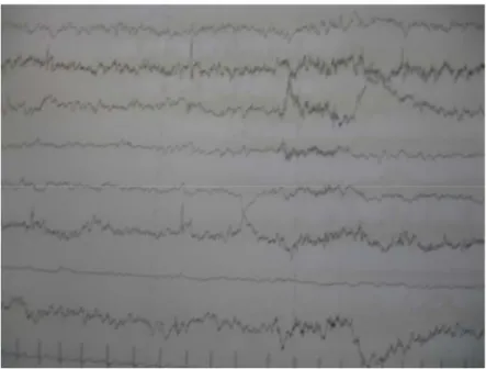 Figure 5 : EEG : tracé symétrique, pointes bilatérales fronto-pariétales.        