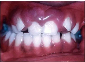 Figure 9 : hyperplasie gingivale et malposition dentaire chez un patient avec SSW. 