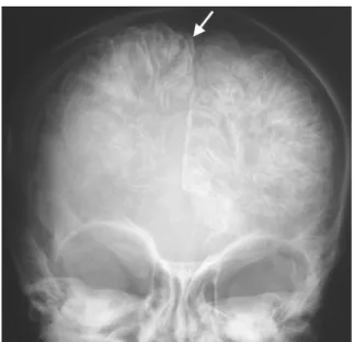 Figure 11: calcifications corticales  2. L’échographie transfontanellaire: 