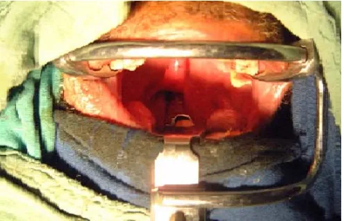 Fig. 2 : vue opératoire avec suspension de la luette avec le palais mou,  par un point de suture