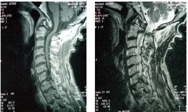 Fig. 7: IRM vetébro-médullaire  objectivant un rachis cervical arthrosique avec un  processus lytique de l’arc antérieur de C1 et du corps de C2 avec compression antérieure de la 