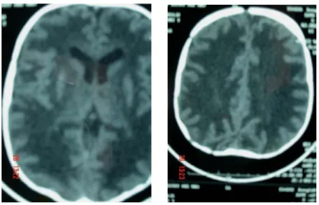 Figure 1: TDM cérébrale montrant des images d’hypodensité  diffuse au niveau de la SB cérébrale