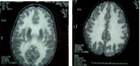 Figure 2 : IRM cérébrale montrant une LD diffuse.    